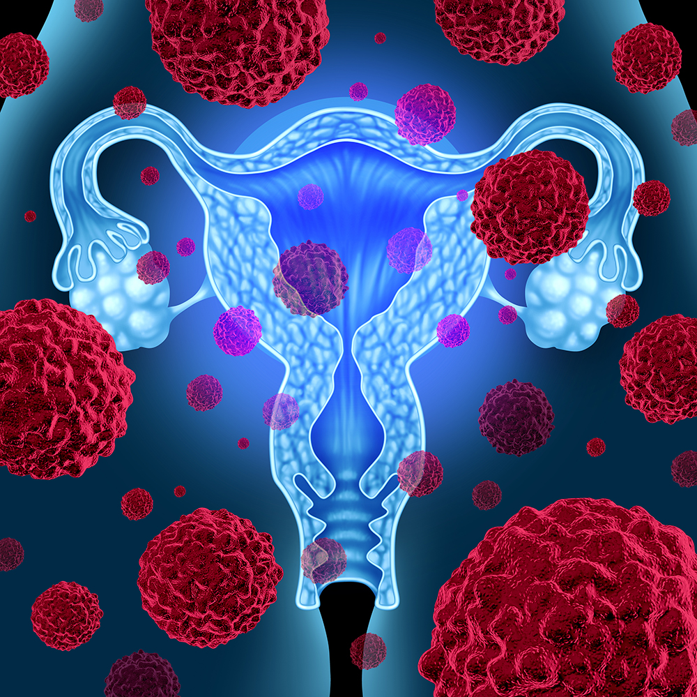 Uterus or uterine cancer medical concept as cancerous cells in a female body attacking the reproductive system as ovaries and fallopian tubes as a symbol of cervical tumor growth treatment and risks